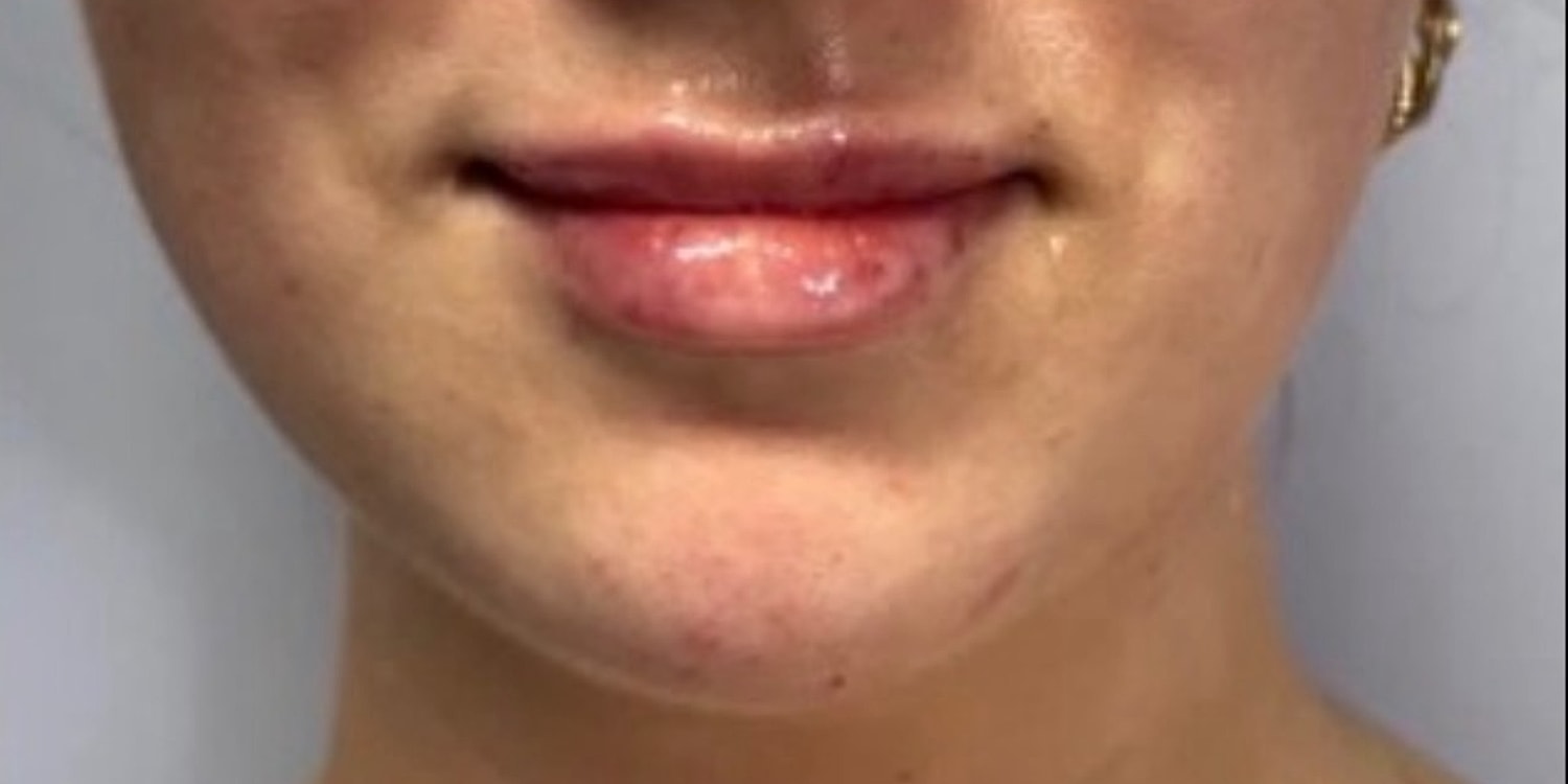 Close-up of lips and chin area.