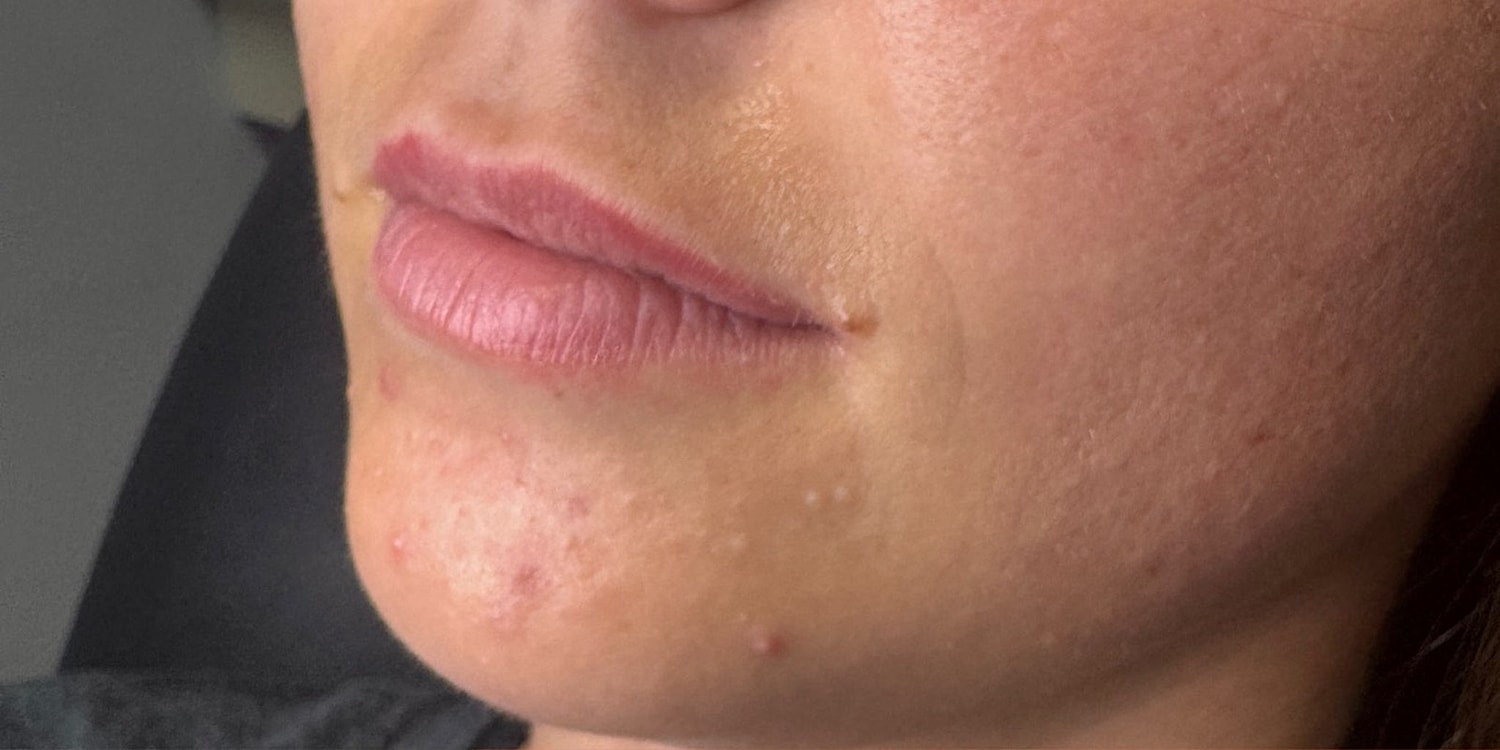 Close-up of lips and chin with skin blemishes.