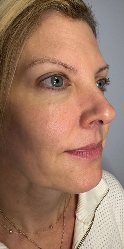 Biostimulators Gallery Before & After