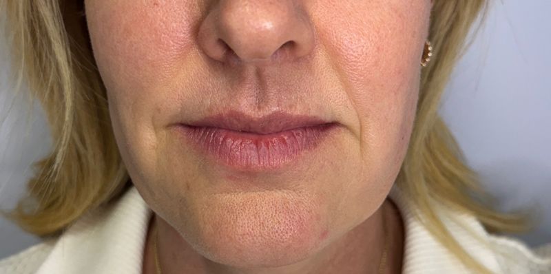 Biostimulators Gallery Before & After